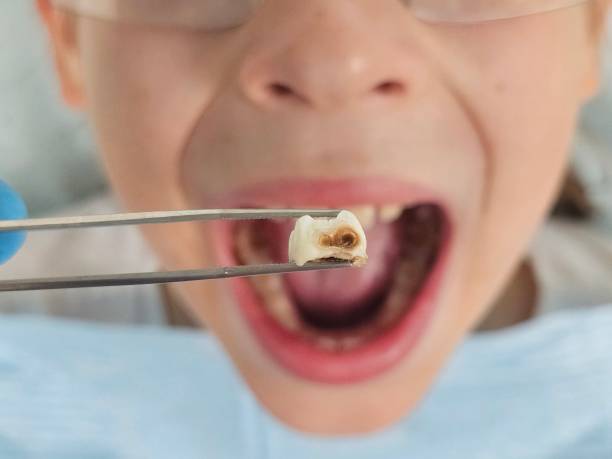 Best Same-Day Emergency Dental Services in Wenona, IL