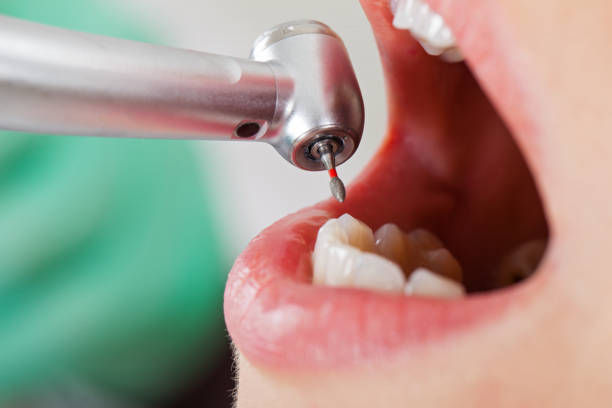 Best Emergency Wisdom Teeth Removal in Wenona, IL